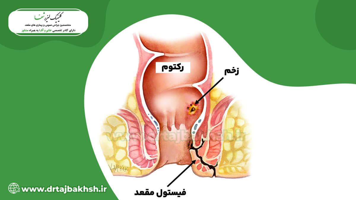 فیستول مقعدی چیست؟ علت بروز فیستول مقعدی و راه های تشخیص آن