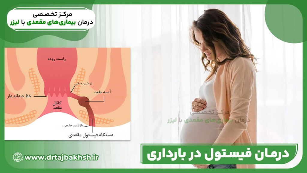 درمان فیستول در بارداری