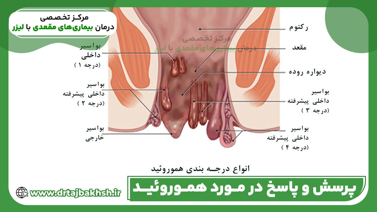 سوالات پرتکرار درباره بواسیر (هموروئید) | پرسش و پاسخ